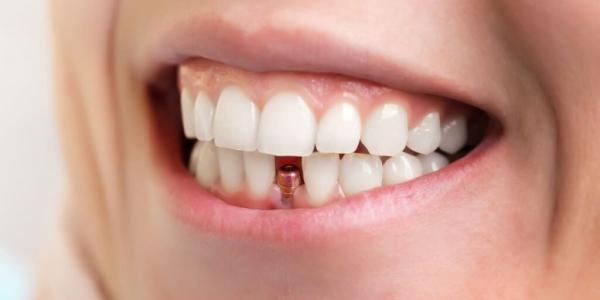 11 دشمن ایمپلنت دندان (شناخت عوامل)