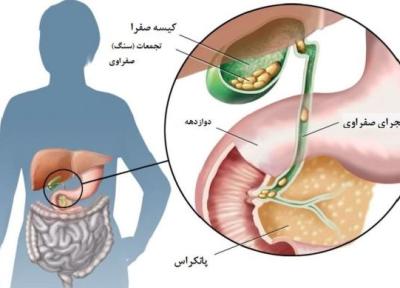با علائم سرطان مجرای صفراوی آشنا شوید